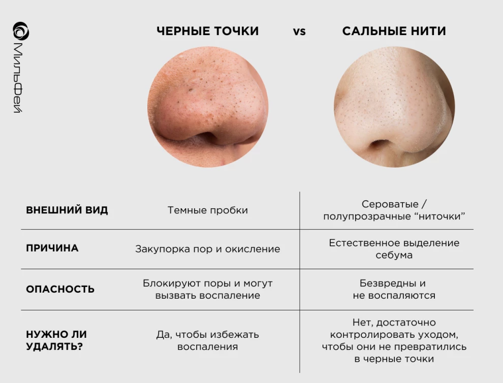 черные точи и сальные нити разница