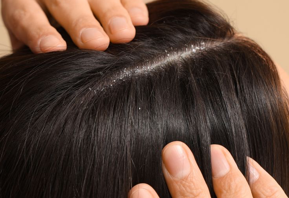 Сухая кожа головы – что делать? Причины, уход и лучшие шампуни