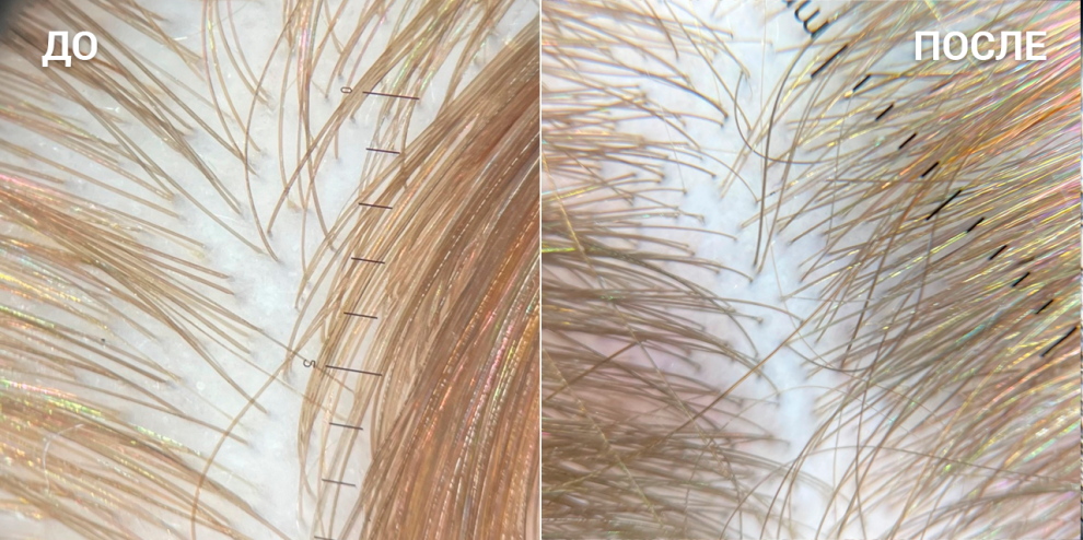 Выпадение волос: причины у мужчин и женщин, лечение, эффективное средство от выпадения