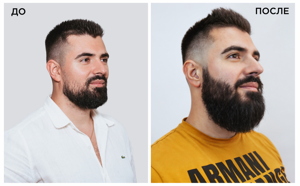 Выпадение волос: причины у мужчин и женщин, лечение, эффективное средство от выпадения