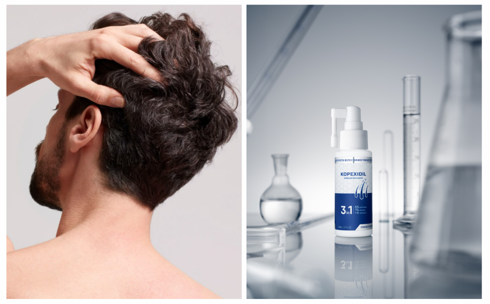 Выпадение волос: причины у мужчин и женщин, лечение, эффективное средство от выпадения