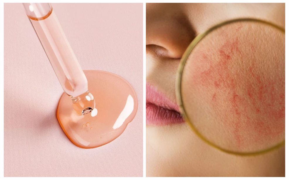 Купероз на лице: что это, как лечить и какие средства помогут. Полное руководство по уходу за кожей с куперозом