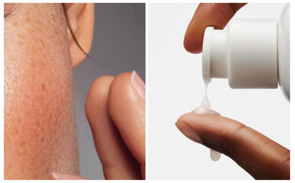 Азелаиновая кислота для лица: что это, эффект и как использовать