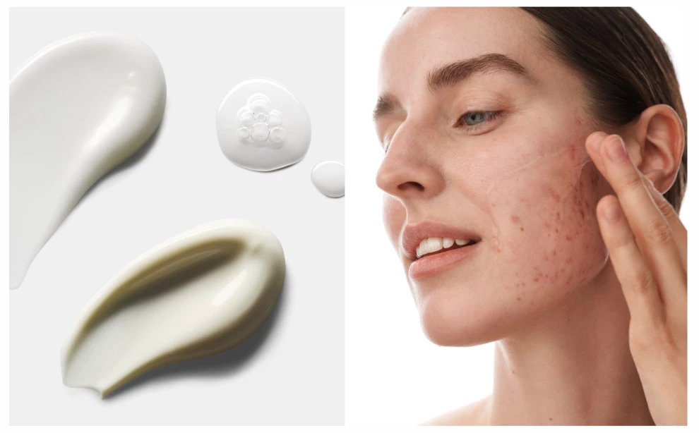 Как избавиться от высыпаний: правильный уход за проблемной кожей. Лучшие средства для очищения, увлажнения и коррекции акне.