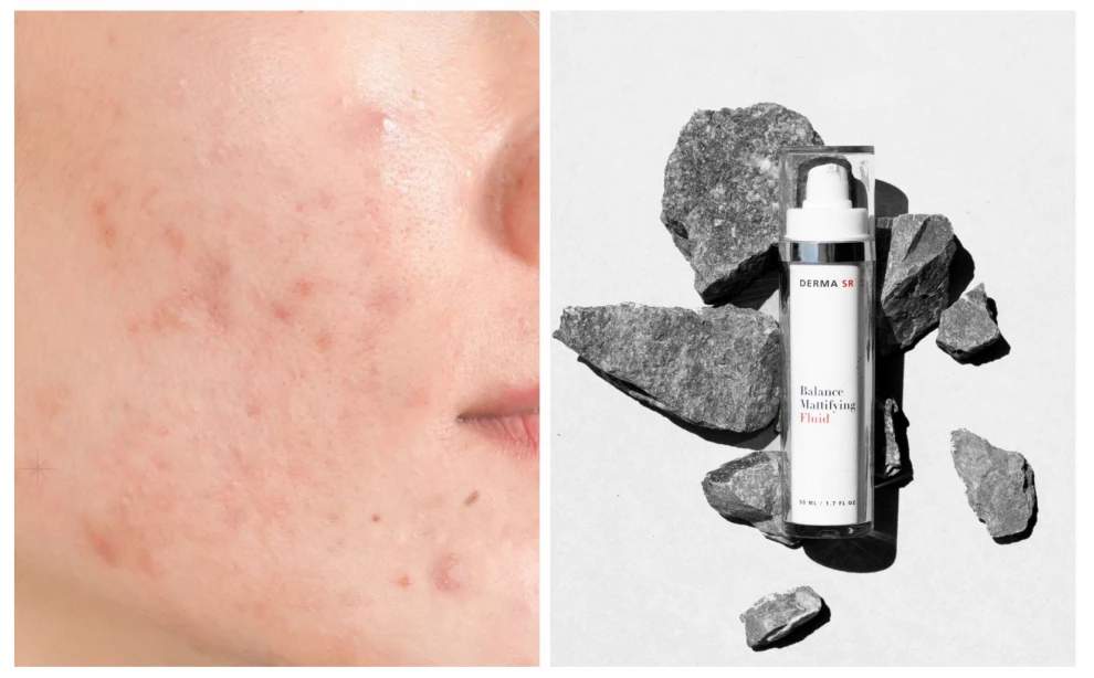 Как избавиться от высыпаний: правильный уход за проблемной кожей. Лучшие средства для очищения, увлажнения и коррекции акне.