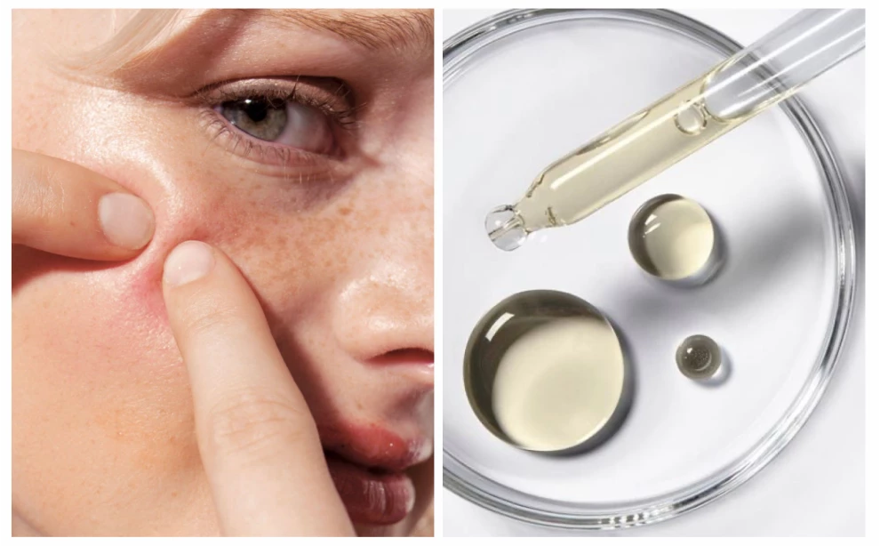 Как избавиться от высыпаний: правильный уход за проблемной кожей. Лучшие средства для очищения, увлажнения и коррекции акне.