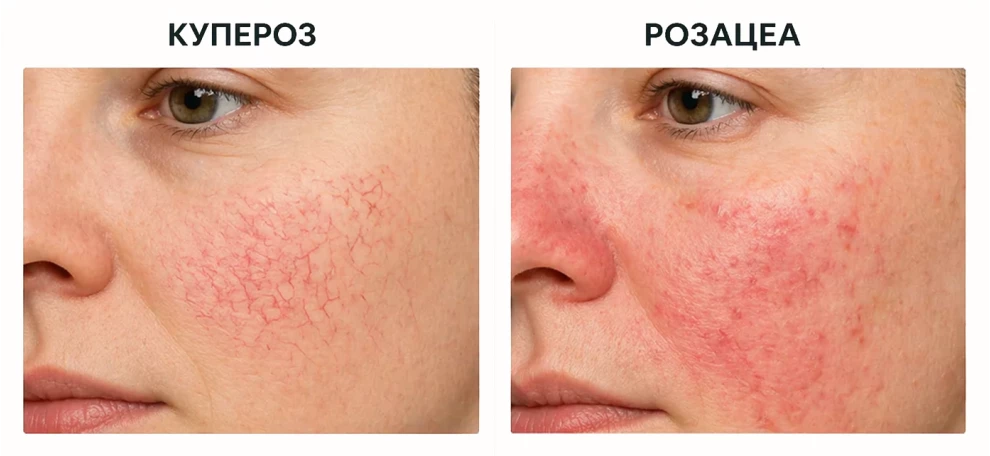 купероз и розацеа, разница, разичия, чем отличается купероз и розацеа, признаки, фото, как выглядит, что это