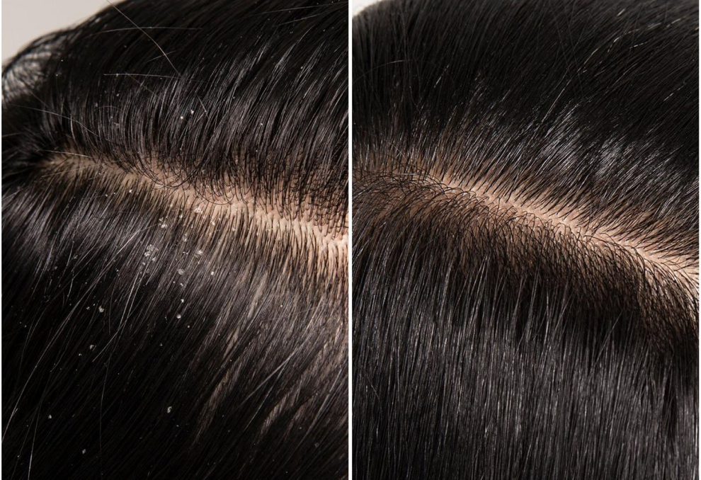 Сухая кожа головы – что делать? Причины, уход и лучшие шампуни