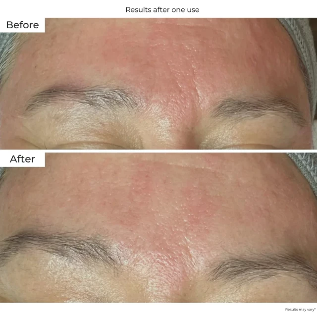 Бото-патч для зоны межбровья - изображение 5