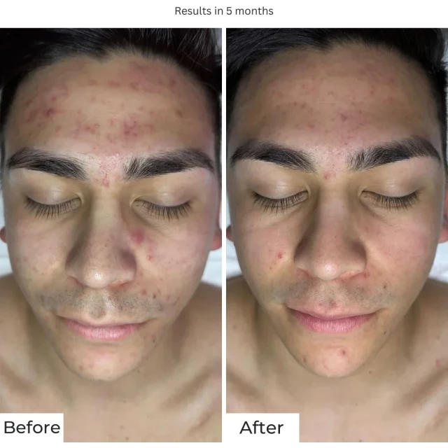 Микропилинг "Бета кислота" - изображение 2