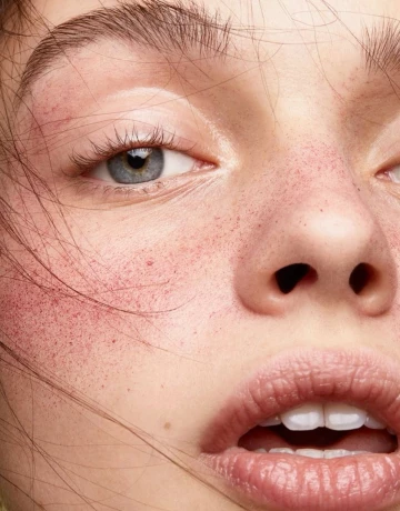 Лечение купероза и розацеа - изображение 1