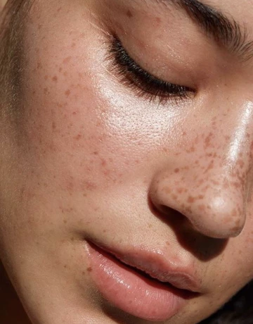 Что такое гиперпигментация? - изображение 2