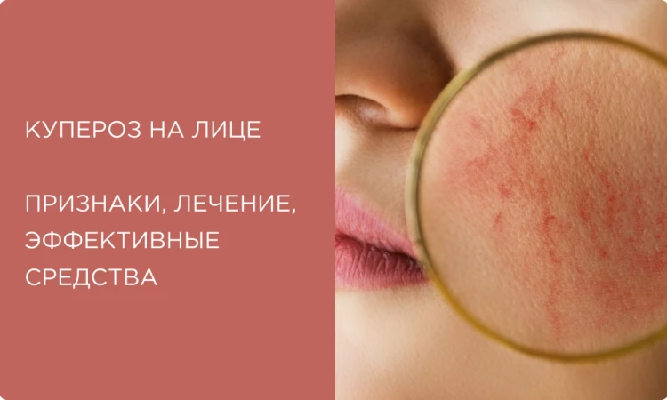 Купероз на лице: что это, как лечить и какие средства действительно работают