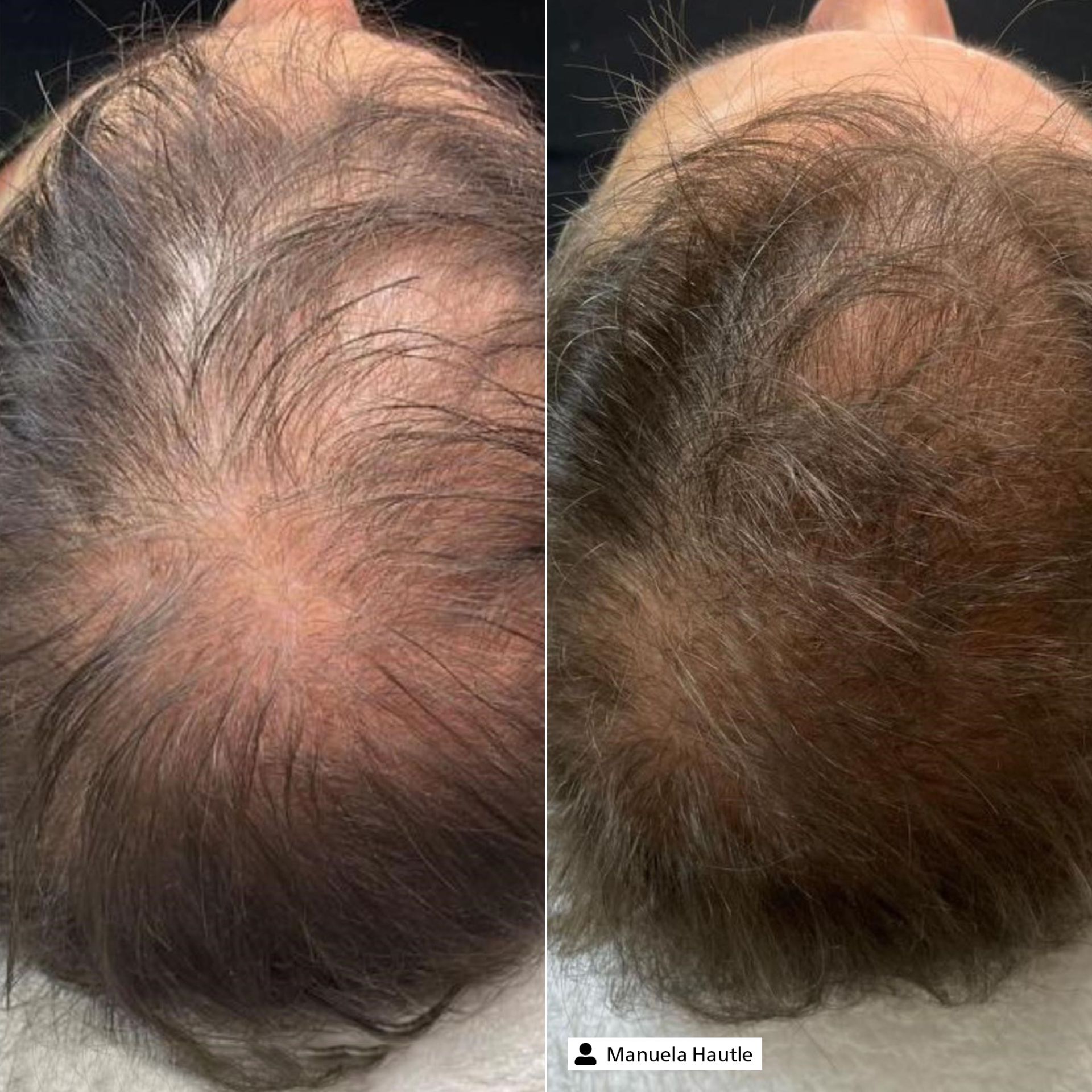 Белок-защитник волосяных фолликулов: ключ к предотвращению облысения